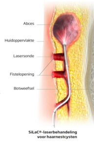 Behandeling haarnestcyste met SiLac